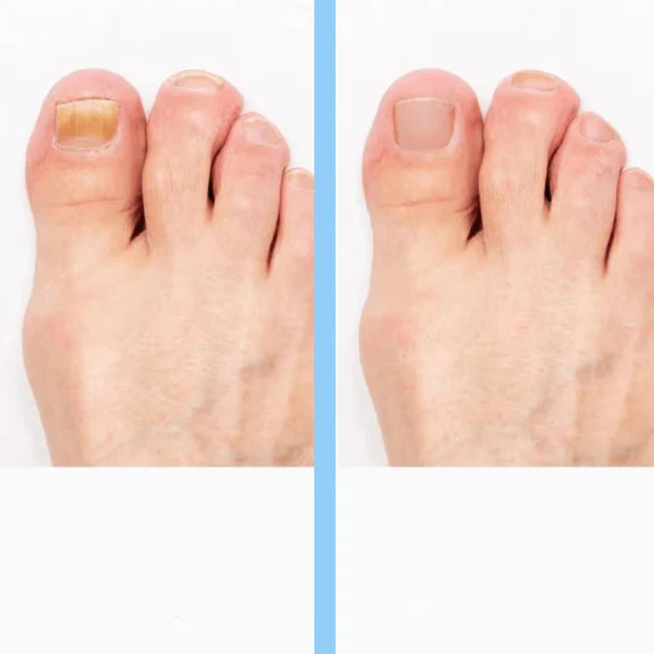 Nail Fungus Treatment Laser Device