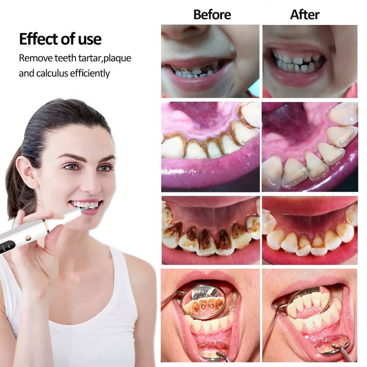 Electric Dental Calculus Remover Kit Adjustable Modes with LED
