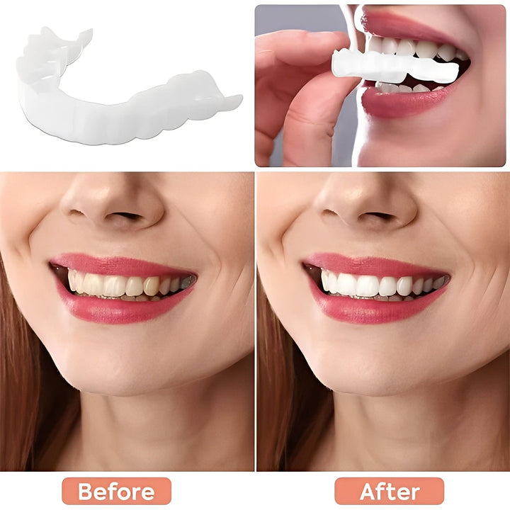 Cosmetic Dental Veneers Natural Finish