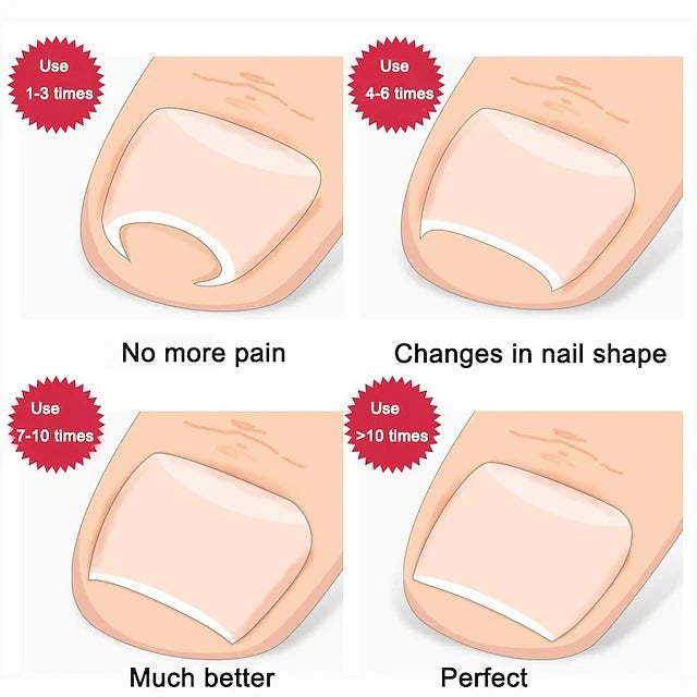 Ingrown Toenail Corrector Tool Stainless Steel Pedicure Care